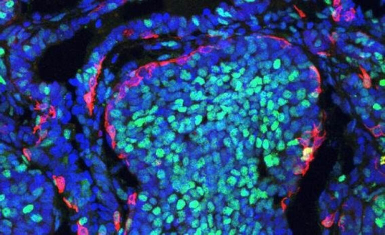 Estudio revela que las células cancerosas compiten a favor y en contra del desarrollo del tumor